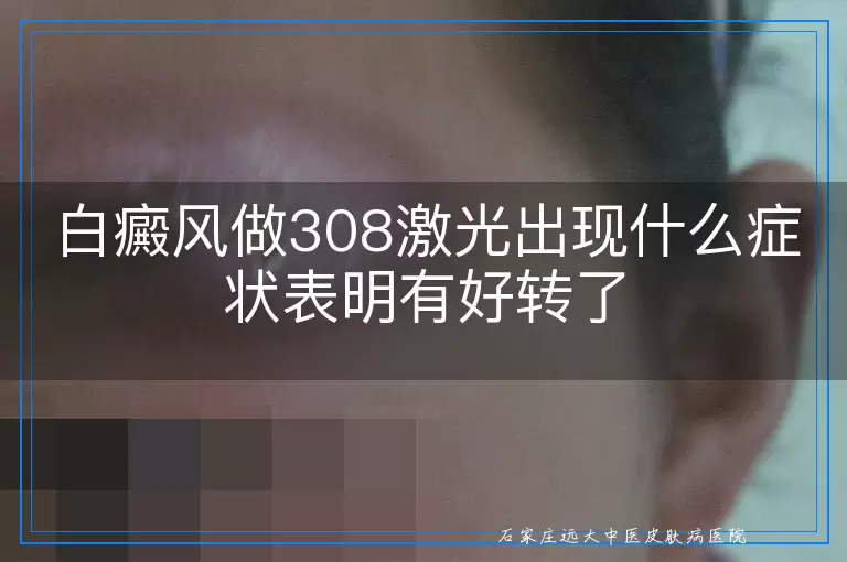 白癜风做308激光出现什么症状表明有好转了