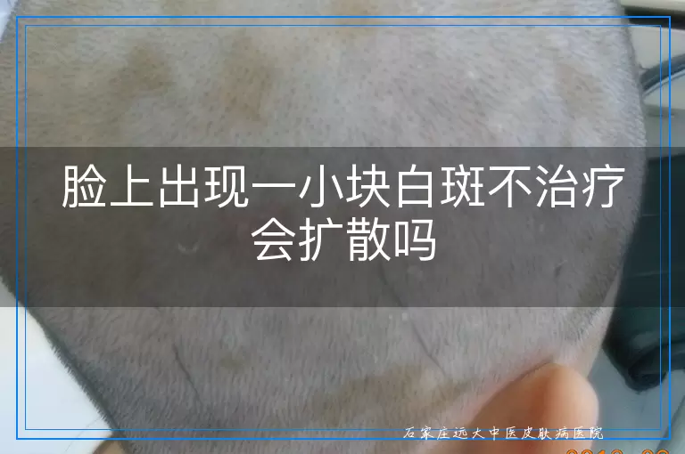 脸上出现一小块白斑不治疗会扩散吗