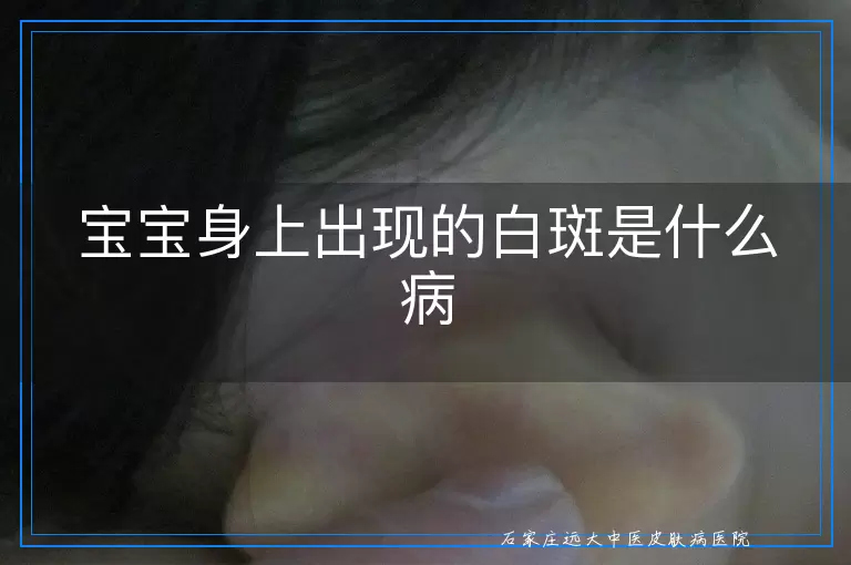 宝宝身上出现的白斑是什么病