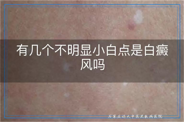 有几个不明显小白点是白癜风吗