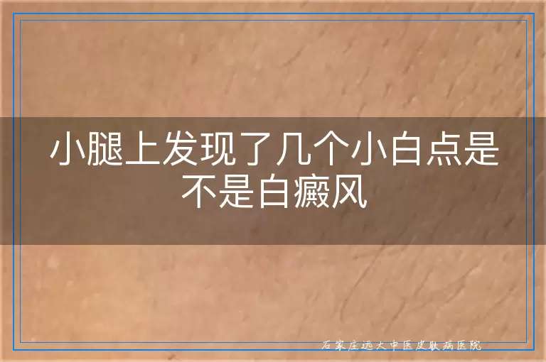小腿上发现了几个小白点是不是白癜风