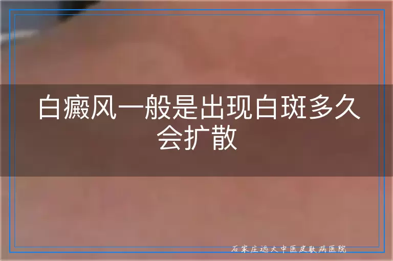 白癜风一般是出现白斑多久会扩散