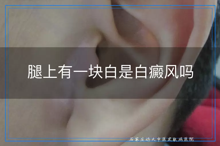 腿上有一块白是白癜风吗