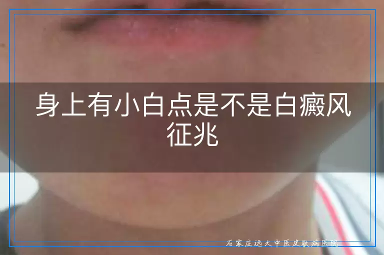 身上有小白点是不是白癜风征兆