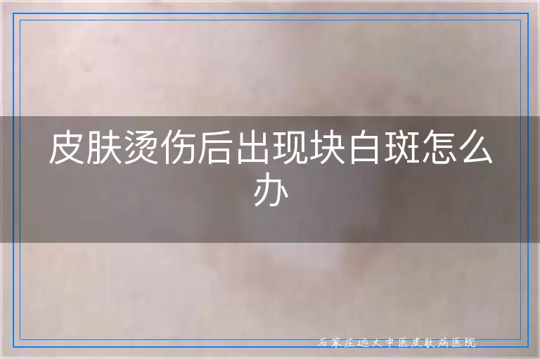 皮肤烫伤后出现块白斑怎么办