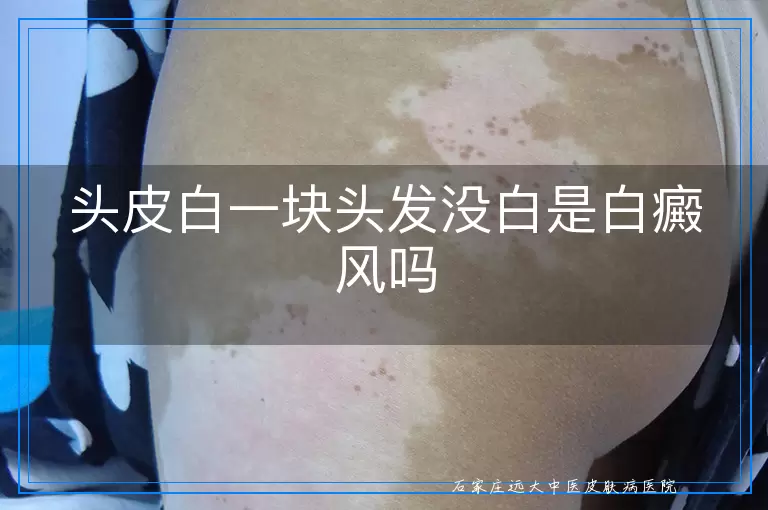 头皮白一块头发没白是白癜风吗