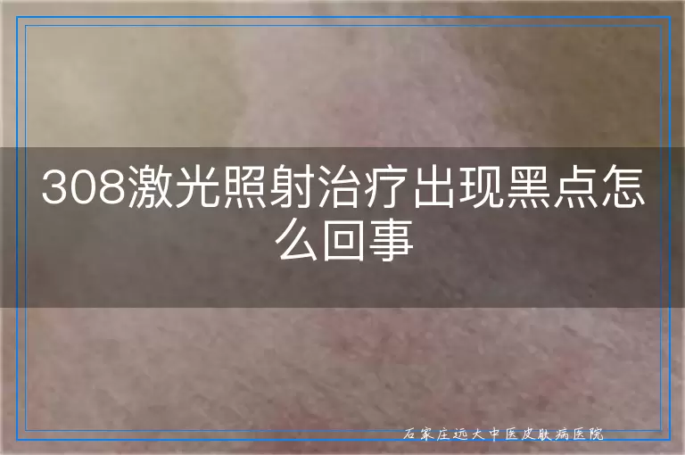 308激光照射治疗出现黑点怎么回事