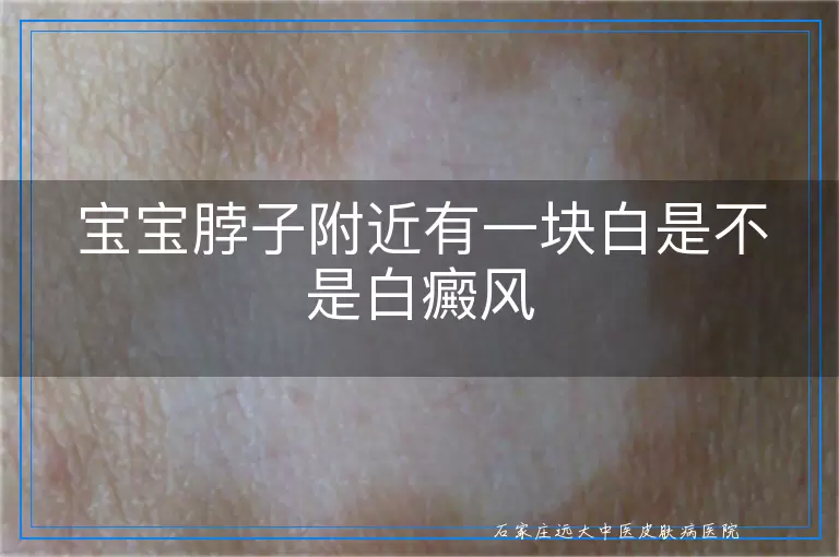宝宝脖子附近有一块白是不是白癜风