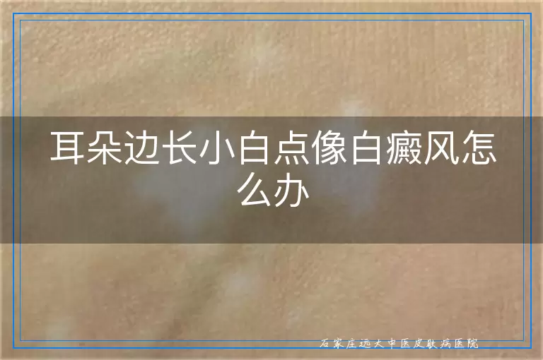 耳朵边长小白点像白癜风怎么办