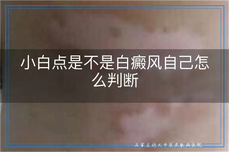 小白点是不是白癜风自己怎么判断