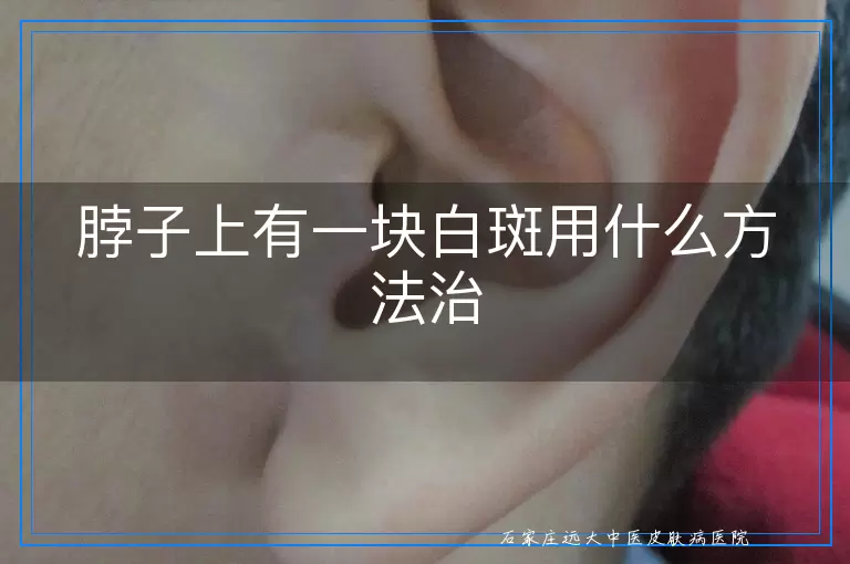 脖子上有一块白斑用什么方法治