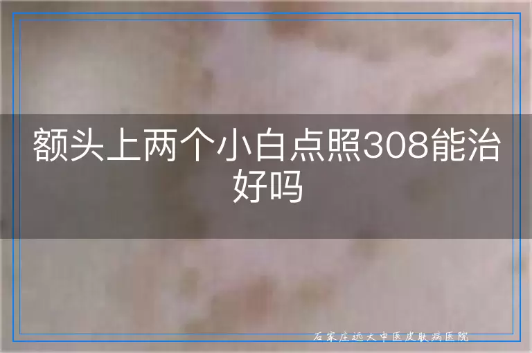额头上两个小白点照308能治好吗