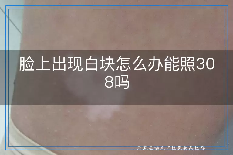 脸上出现白块怎么办能照308吗