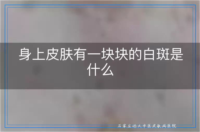 身上皮肤有一块块的白斑是什么