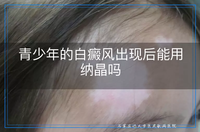 青少年的白癜风出现后能用纳晶吗