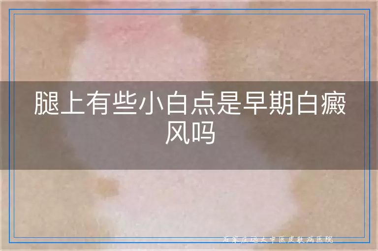 腿上有些小白点是早期白癜风吗