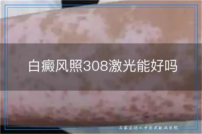 白癜风照308激光能好吗