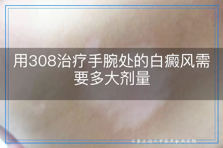 用308治疗手腕处的白癜风需要多大剂量