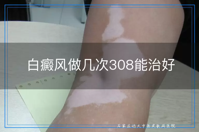 白癜风做几次308能治好