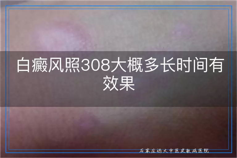 白癜风照308大概多长时间有效果