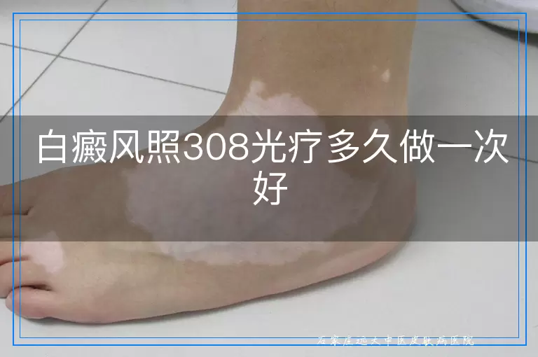 白癜风照308光疗多久做一次好