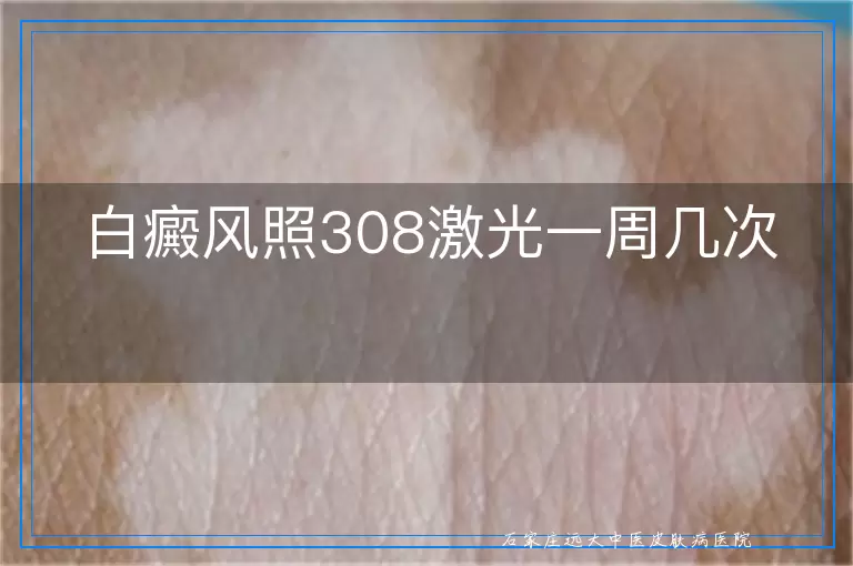 白癜风照308激光一周几次