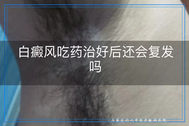 白癜风吃药治好后还会复发吗