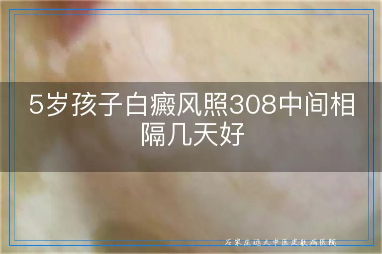 5岁孩子白癜风照308中间相隔几天好