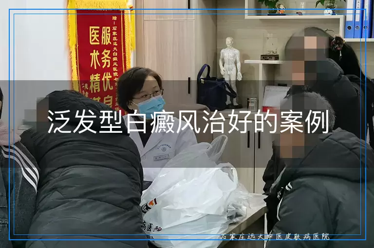泛发型白癜风治好的案例