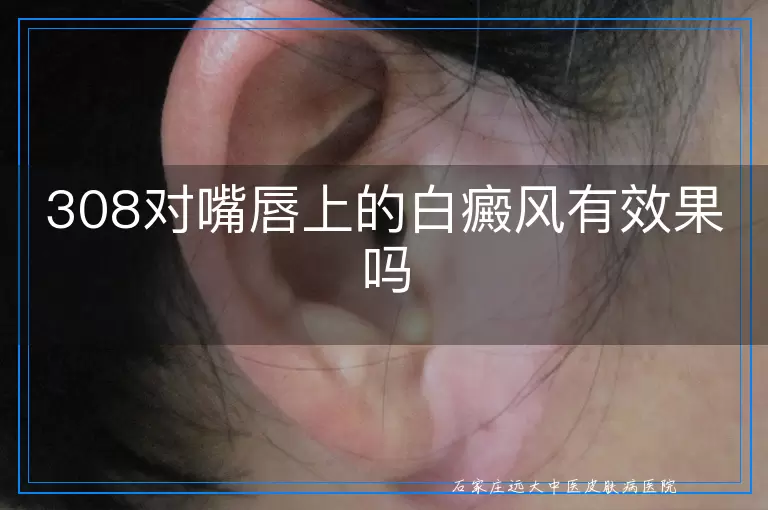 308对嘴唇上的白癜风有效果吗