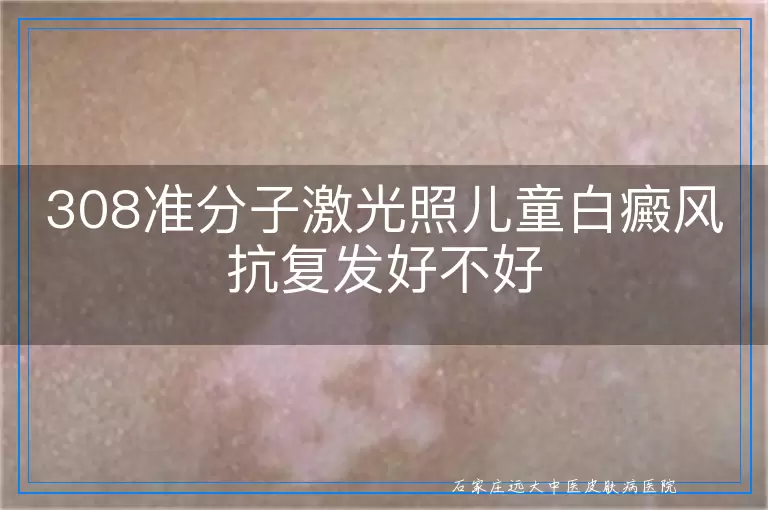 308准分子激光照儿童白癜风抗复发好不好