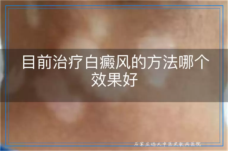 目前治疗白癜风的方法哪个效果好