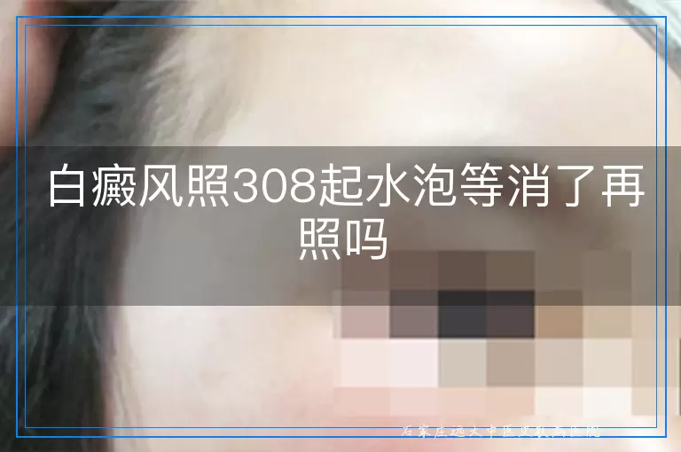 白癜风照308起水泡等消了再照吗
