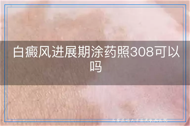 白癜风进展期涂药照308可以吗