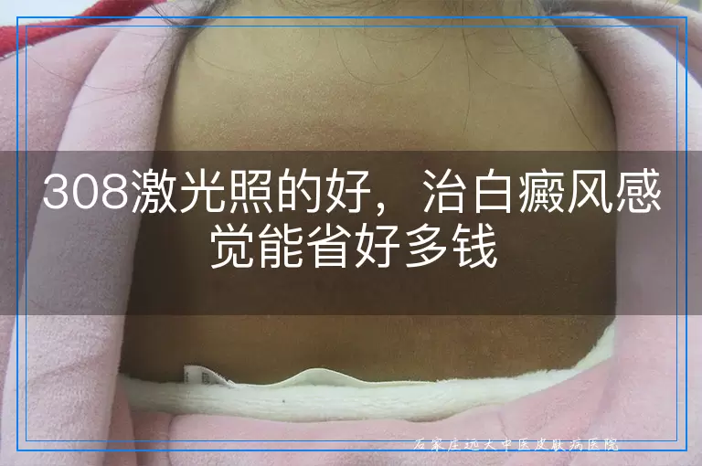 308激光照的好，治白癜风感觉能省好多钱