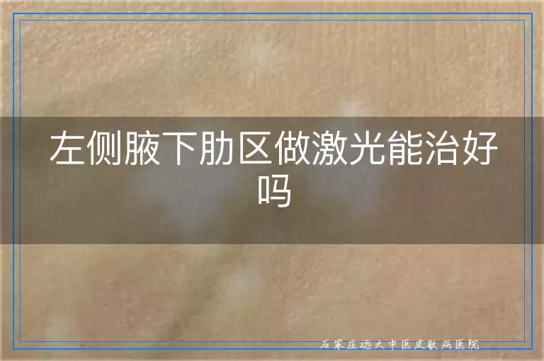 左侧腋下肋区做激光能治好吗