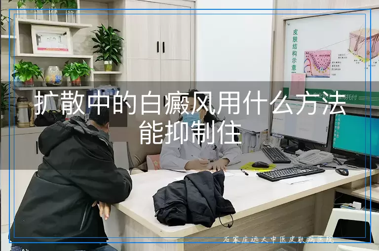 扩散中的白癜风用什么方法能抑制住