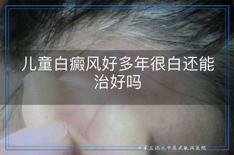 儿童白癜风好多年很白还能治好吗