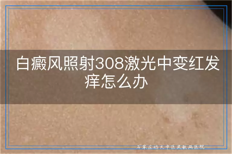 白癜风照射308激光中变红发痒怎么办