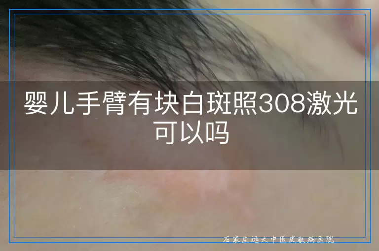 婴儿手臂有块白斑照308激光可以吗
