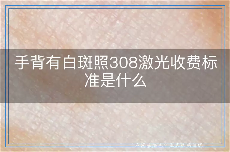 手背有白斑照308激光收费标准是什么