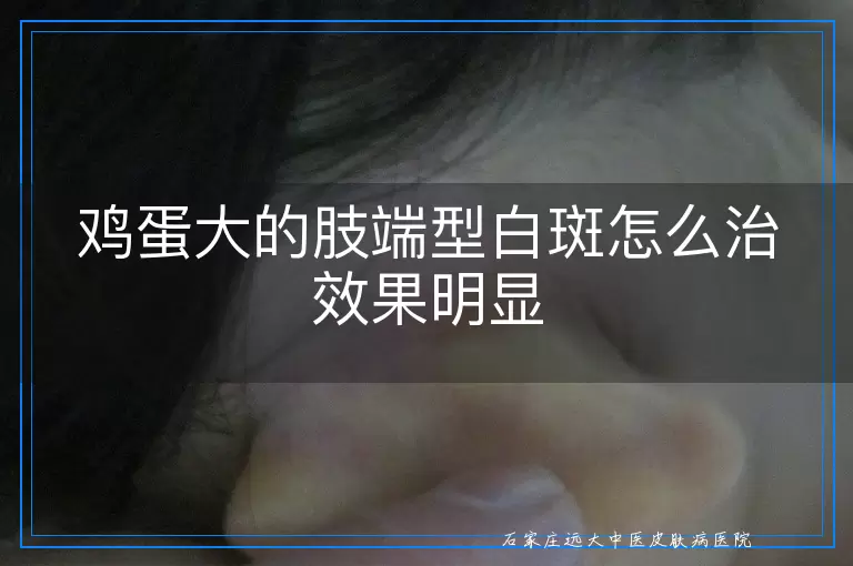 鸡蛋大的肢端型白斑怎么治效果明显