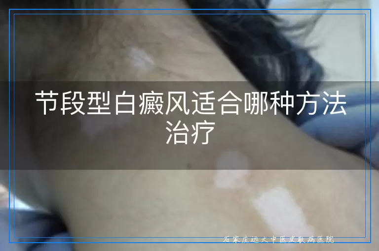 节段型白癜风适合哪种方法治疗