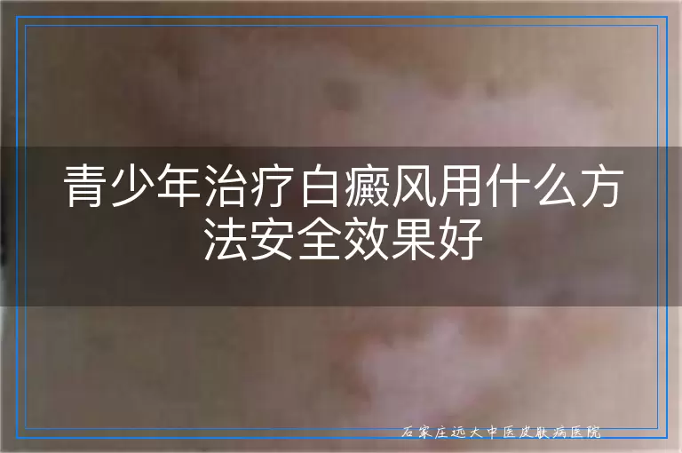 青少年治疗白癜风用什么方法安全效果好