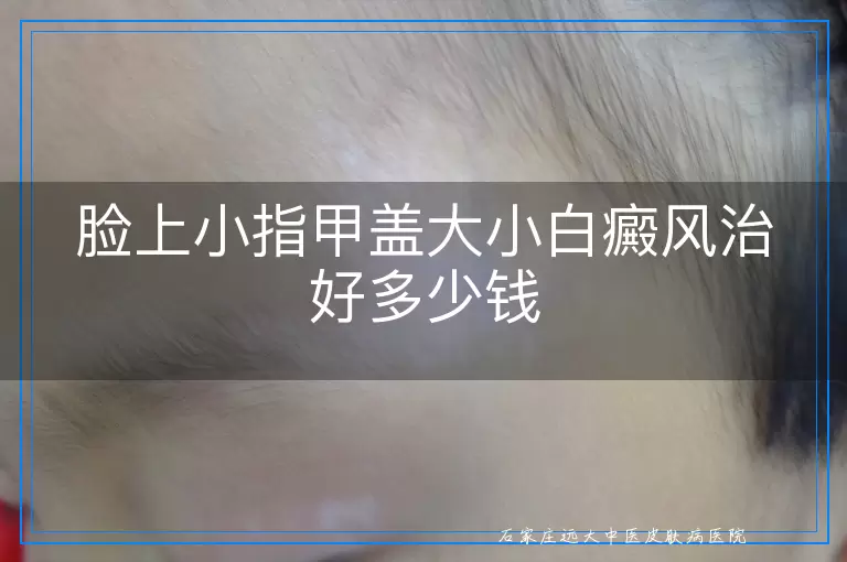 脸上小指甲盖大小白癜风治好多少钱