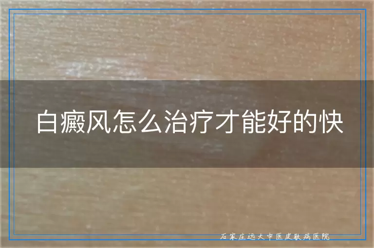 白癜风怎么治疗才能好的快