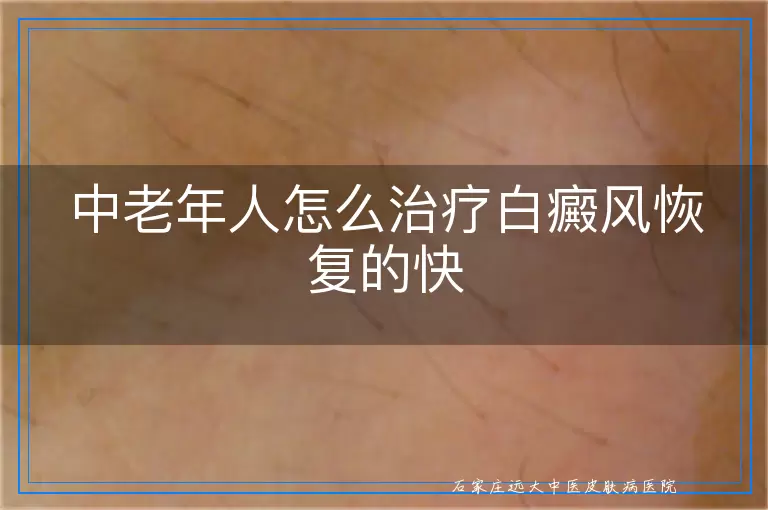 中老年人怎么治疗白癜风恢复的快