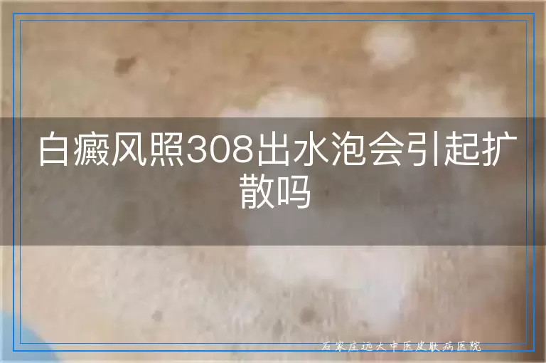 白癜风照308出水泡会引起扩散吗