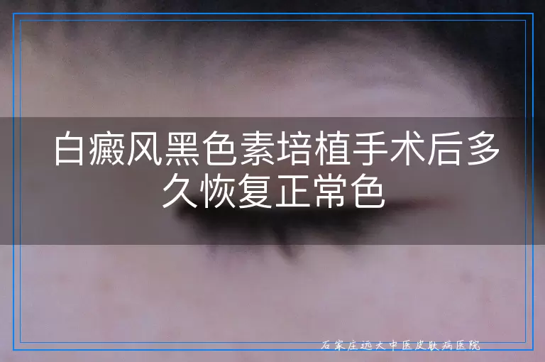 白癜风黑色素培植手术后多久恢复正常色