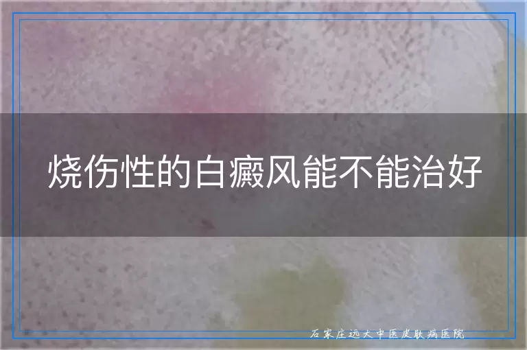 烧伤性的白癜风能不能治好